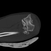 SPORK, NICO - 22.03.1976 - 02.08.2022 - CT obere Extremität - 18:02:23